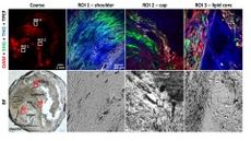 Multimodal optoacoustic and multiphoton microscopy (MPOM) of human carotid atheroma.