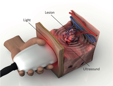 Example of a handheld MSOT device developed for skin imaging.